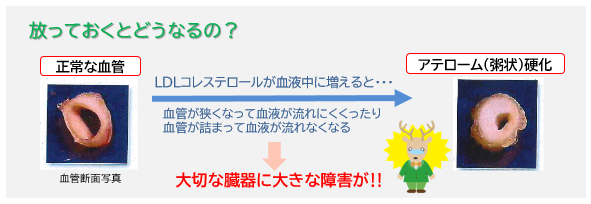 脂質異常症コラム令和７年７月画像３