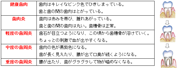 歯周病の段階と症状