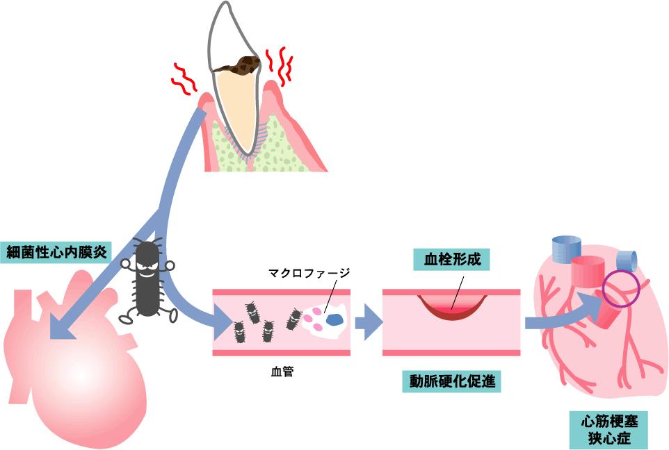 心 細菌 炎 性 内 膜