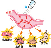 塩分で高血圧