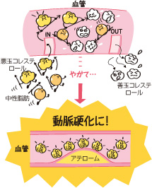 脂質のとりすぎで動脈硬化に