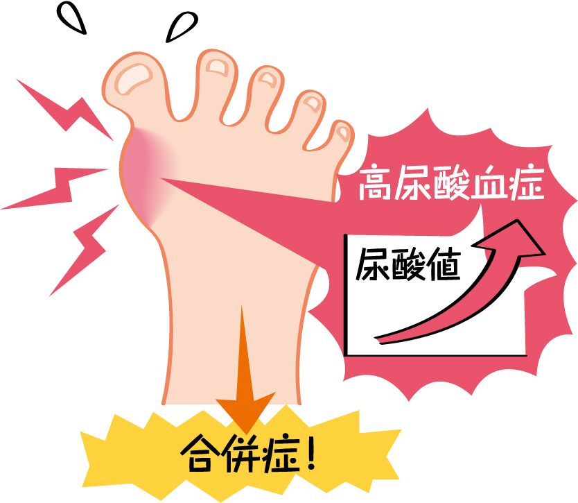 痛風 ある日突然 激痛におそわれます 健康サポート 全国健康保険協会 痛風 ある日突然 激痛におそわれます 健康サポート 全国健康保険協会
