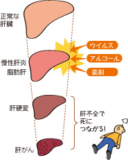 病気 肝臓