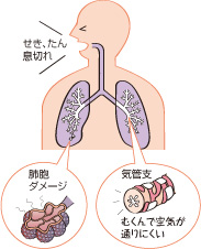 肺 が 硬く なる 病気