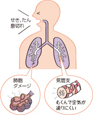 呼吸器の病気 肺の生活習慣病といわれる 慢性閉塞性肺疾患 Copd 健康サポート 全国健康保険協会