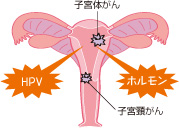 子宮がん